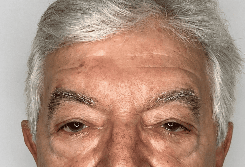 blefaroplastia antes y despues​