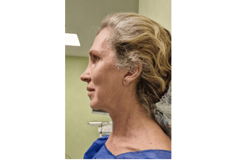 lifting facial antes y despues​