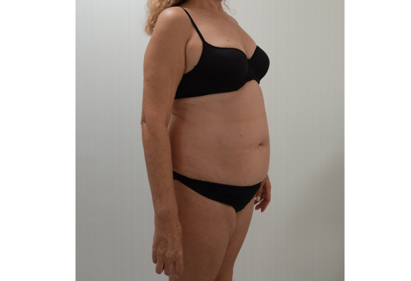 abdominoplastia fotos reales​