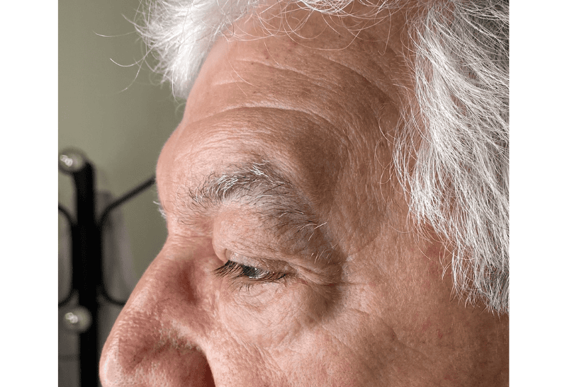 blefaroplastia antes y despues​