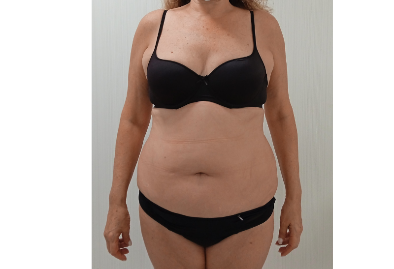 abdominoplastia fotos reales​