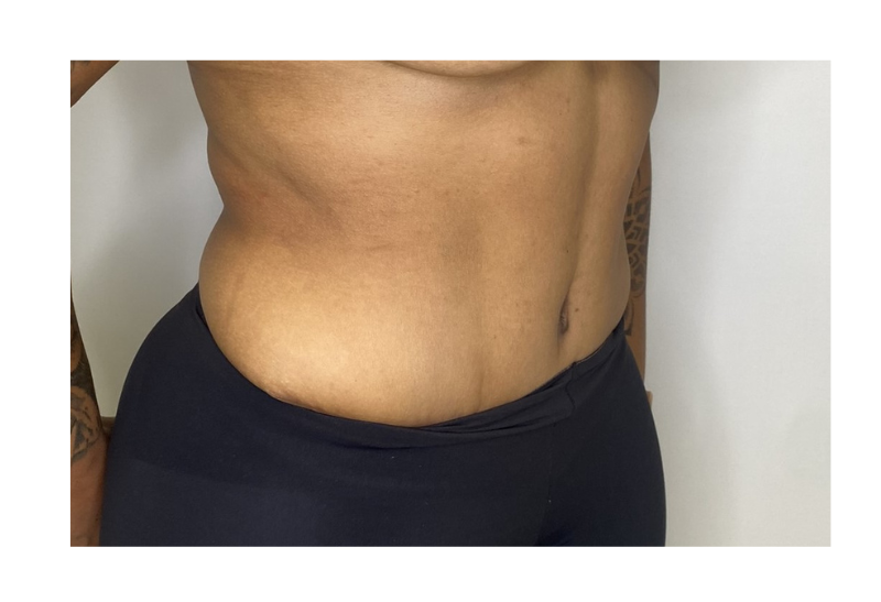 abdominoplastia fotos reales​