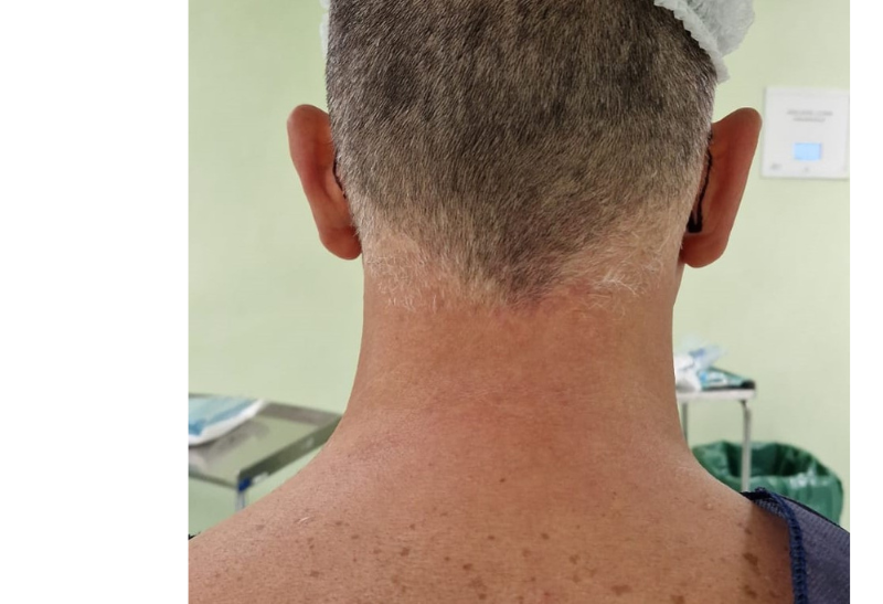 antes y despues otoplastia