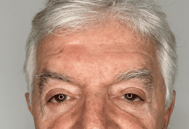 blefaroplastia antes y despues​