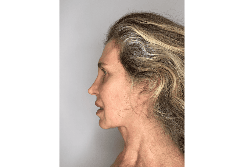 lifting facial antes y despues​