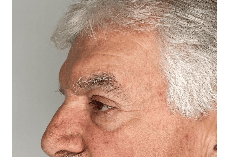 blefaroplastia antes y despues​