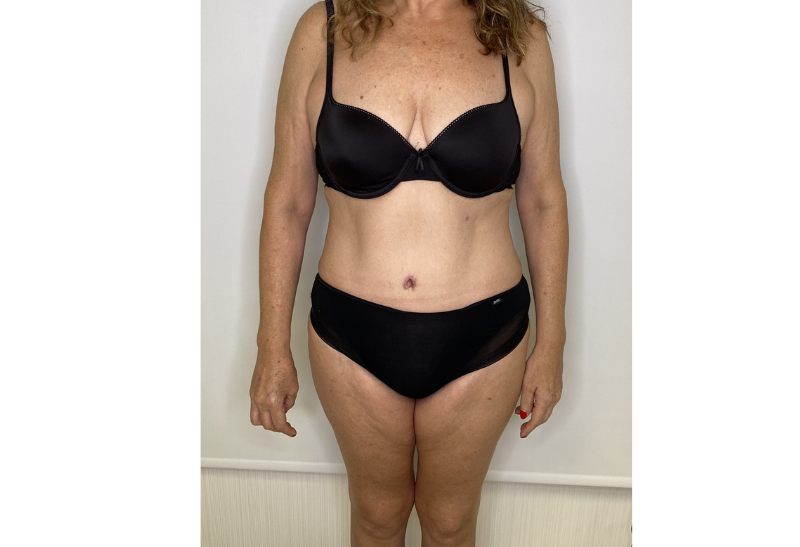 abdominoplastia fotos reales​