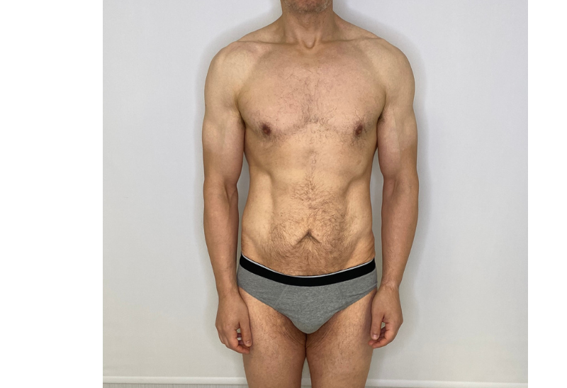 abdominoplastia fotos reales​