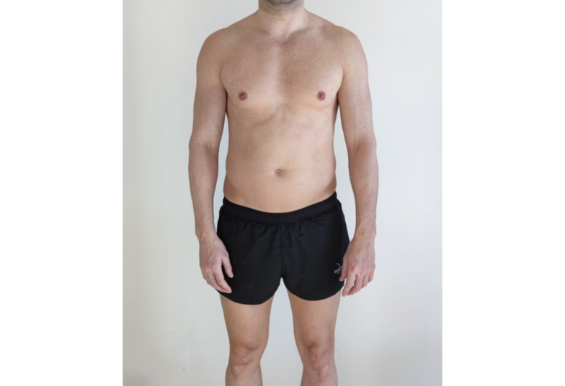 liposuccion antes y despues​