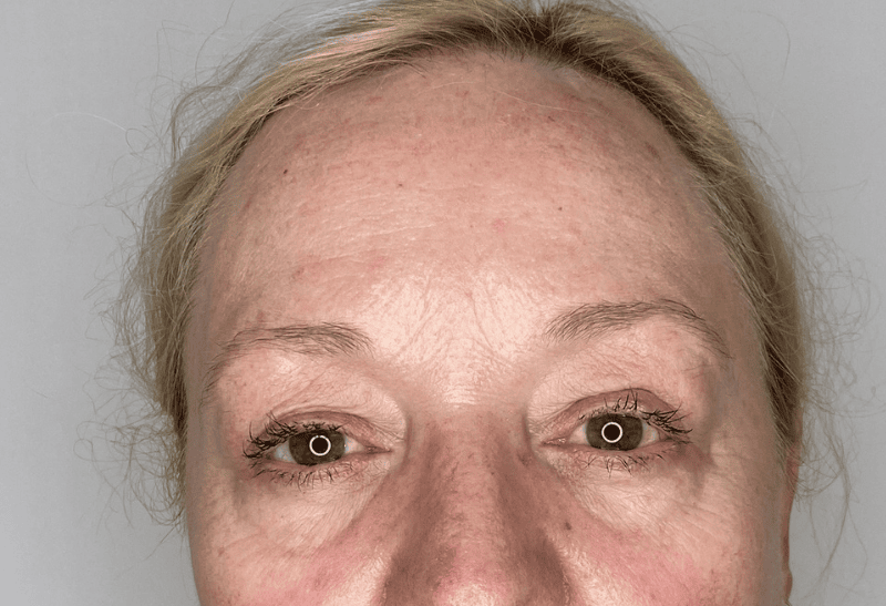 blefaroplastia antes y despues​