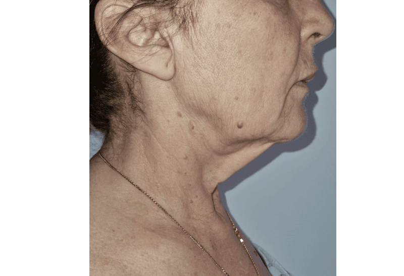 lifting facial antes y despues​