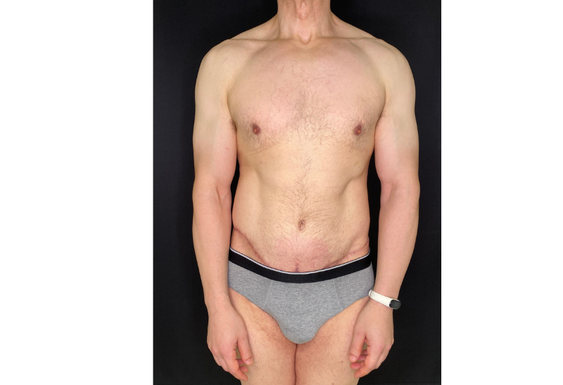 abdominoplastia fotos reales​