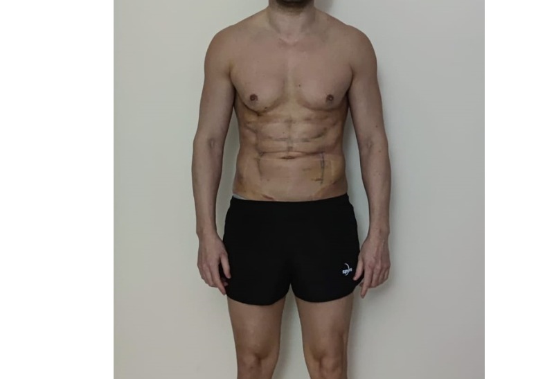 liposuccion antes y despues​