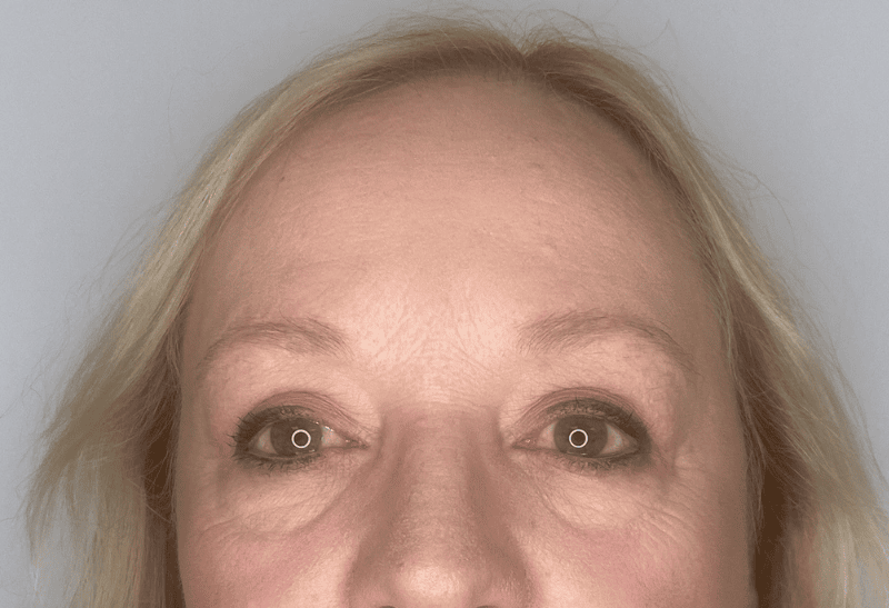 blefaroplastia antes y despues​