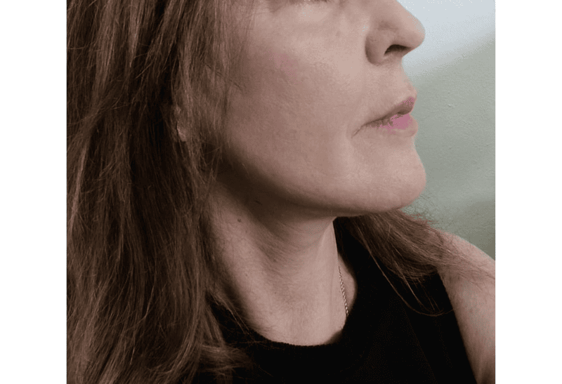 lifting facial antes y despues​