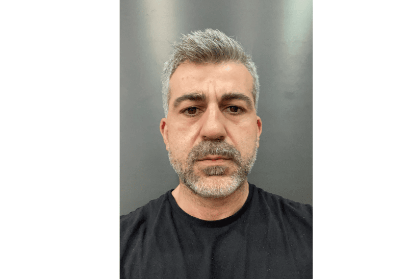 relleno facial con grasa antes y despues