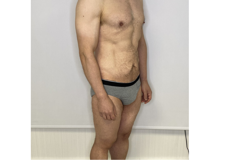 abdominoplastia fotos reales​