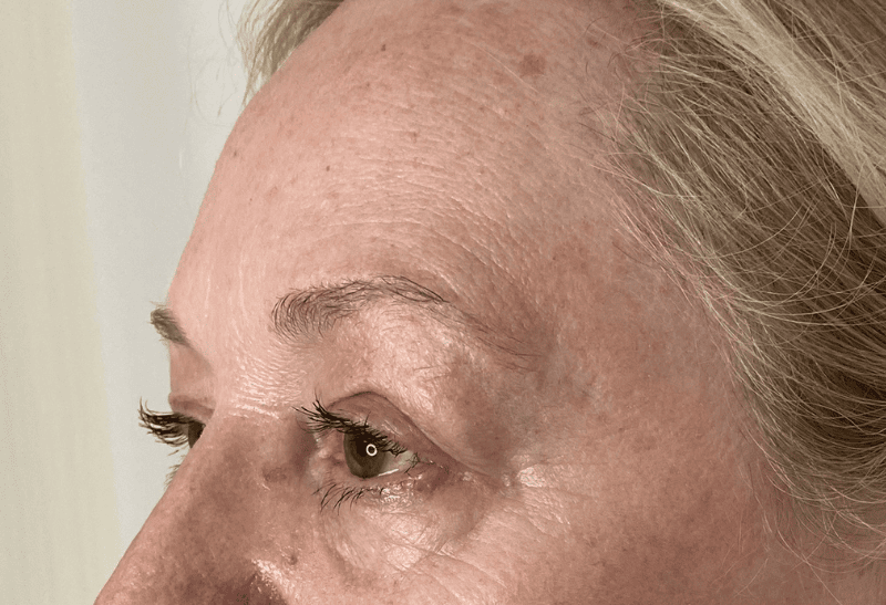 blefaroplastia antes y despues​
