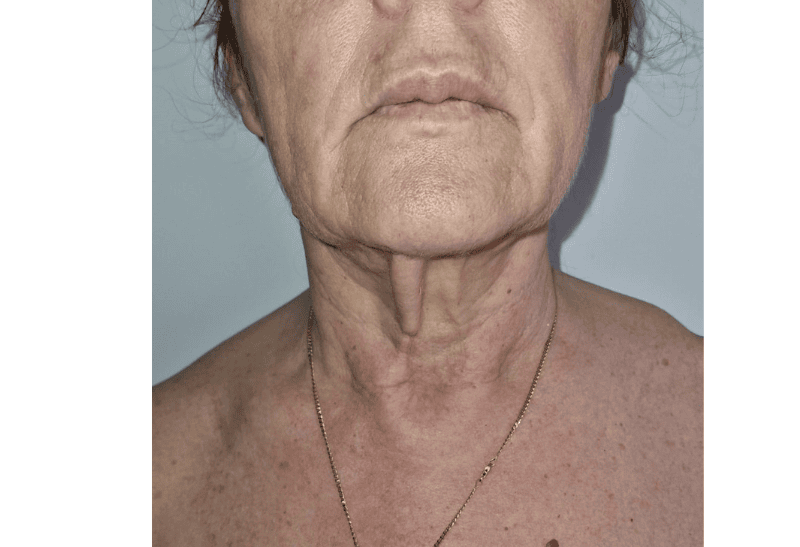 lifting facial antes y despues​