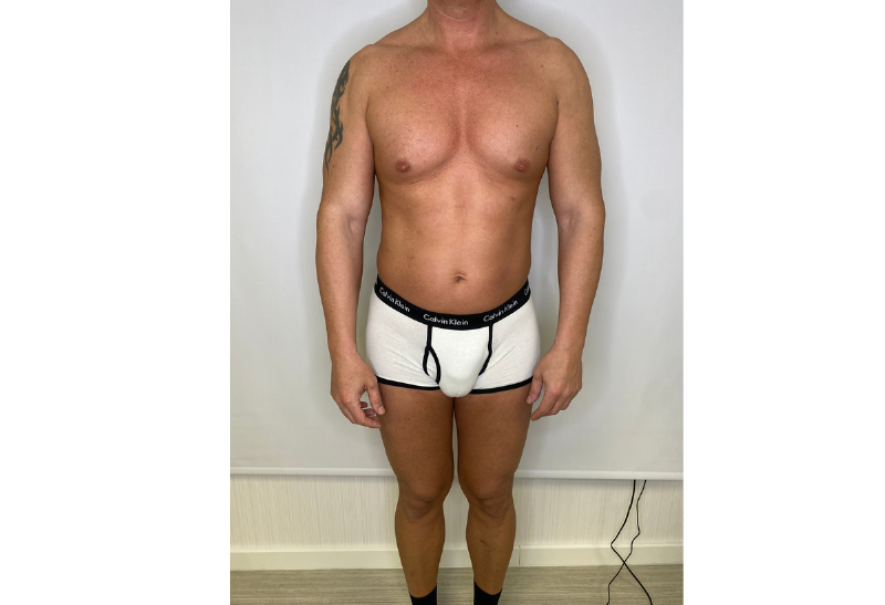 liposuccion antes y despues​
