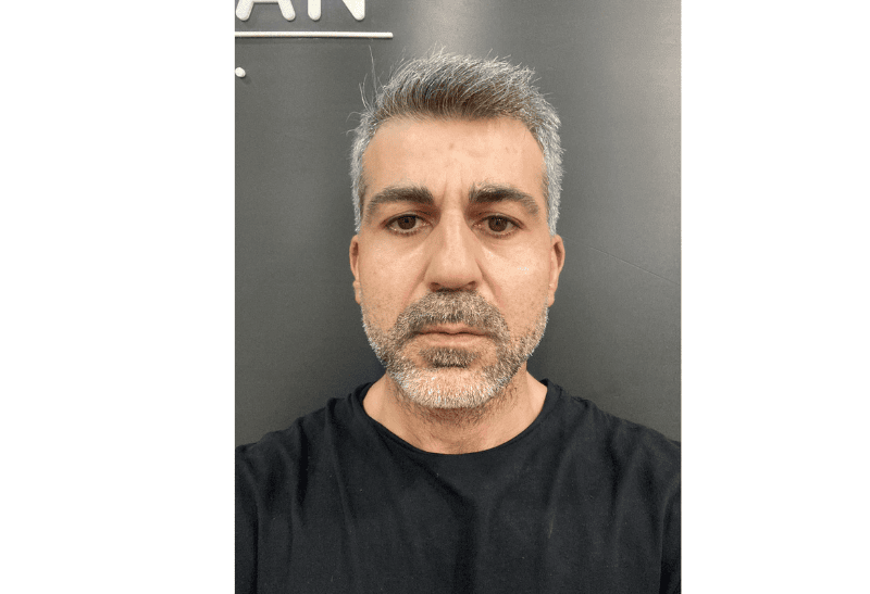 relleno facial con grasa antes y despues