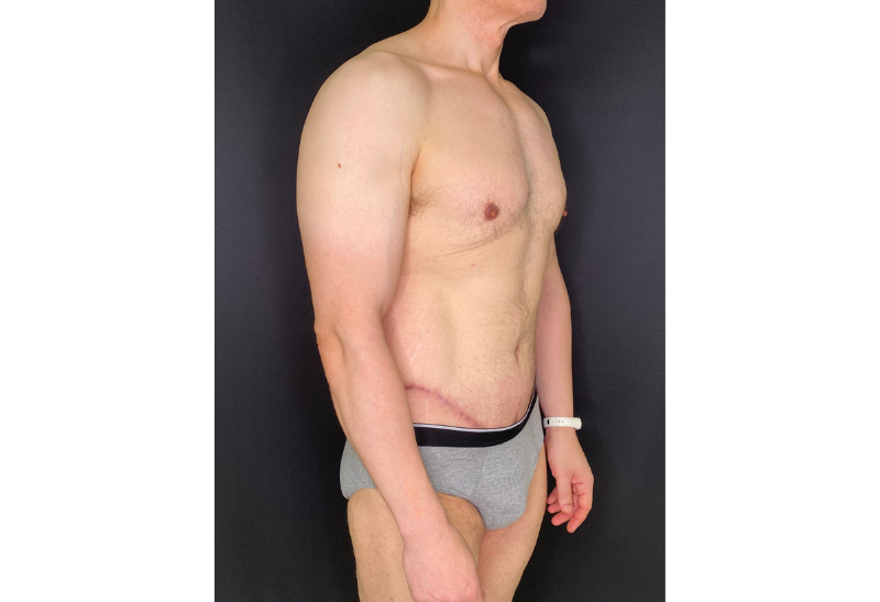 abdominoplastia fotos reales​