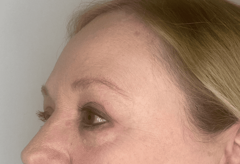 blefaroplastia antes y despues​