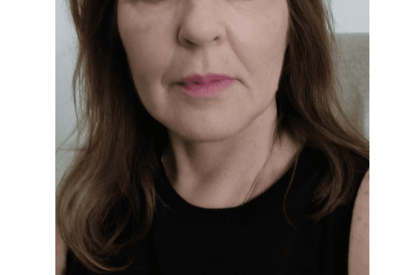 lifting facial antes y despues​