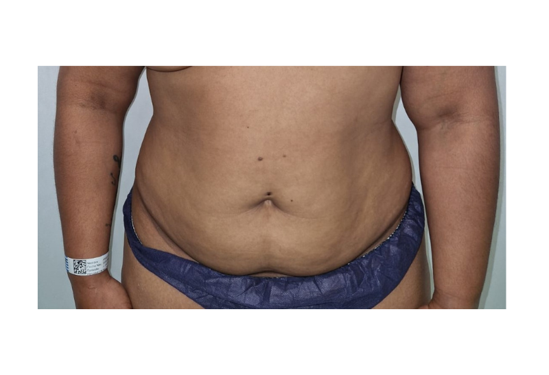 abdominoplastia fotos reales​