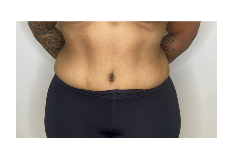 abdominoplastia fotos reales​