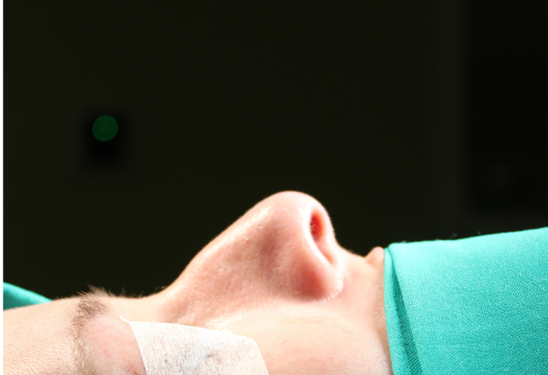 rinoplastia antes y despues