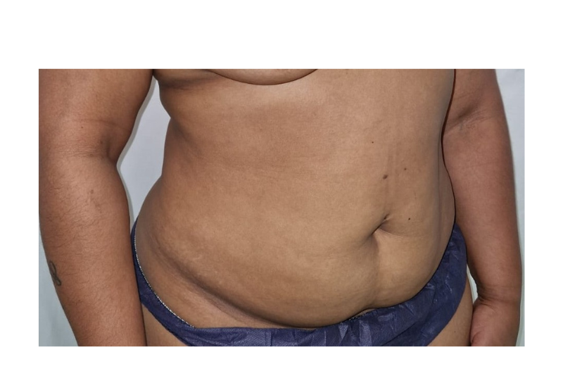 abdominoplastia fotos reales​