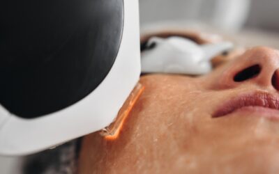 Cómo actúa el láser IPL en el tratamiento de manchas faciales