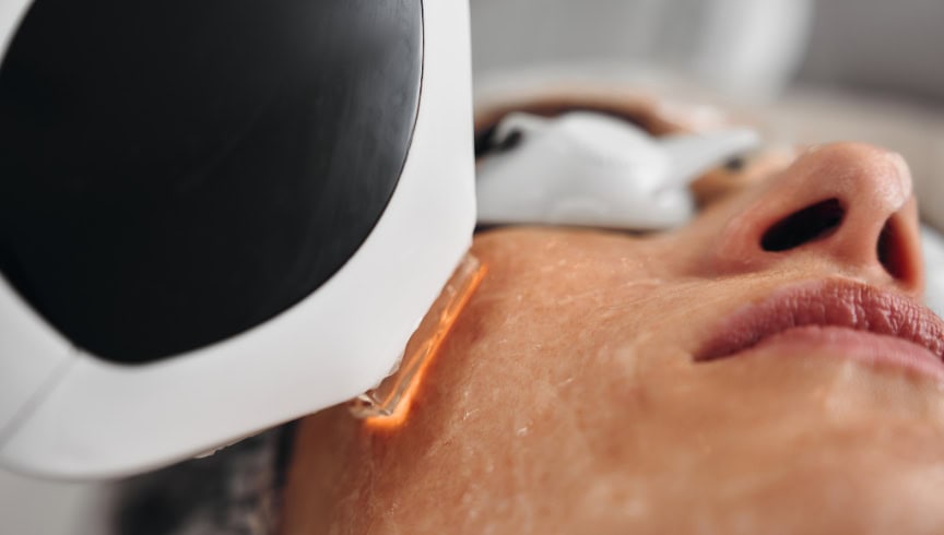 Cómo actúa el láser IPL en el tratamiento de manchas faciales