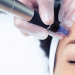 Descubre los resultados del Dermapen, el tratamiento que estimula el colágeno y mejora textura, cicatrices y luminosidad de la piel.-1
