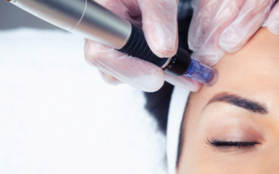 Resultados del Dermapen: cómo mejora la textura y el tono de tu piel