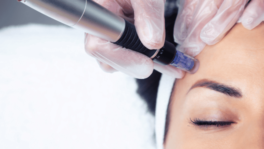 22 Descubre los resultados del Dermapen, el tratamiento que estimula el colágeno y mejora textura, cicatrices y luminosidad de la piel.-1