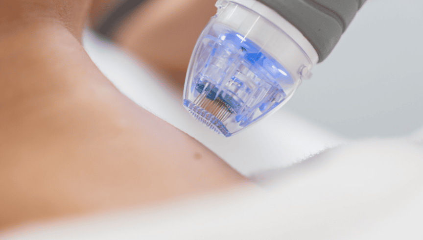 Resultados del Dermapen: cómo mejora la textura y el tono de tu piel Descubre los resultados del Dermapen, el tratamiento que estimula el colágeno y mejora textura, cicatrices y luminosidad de la piel.-2