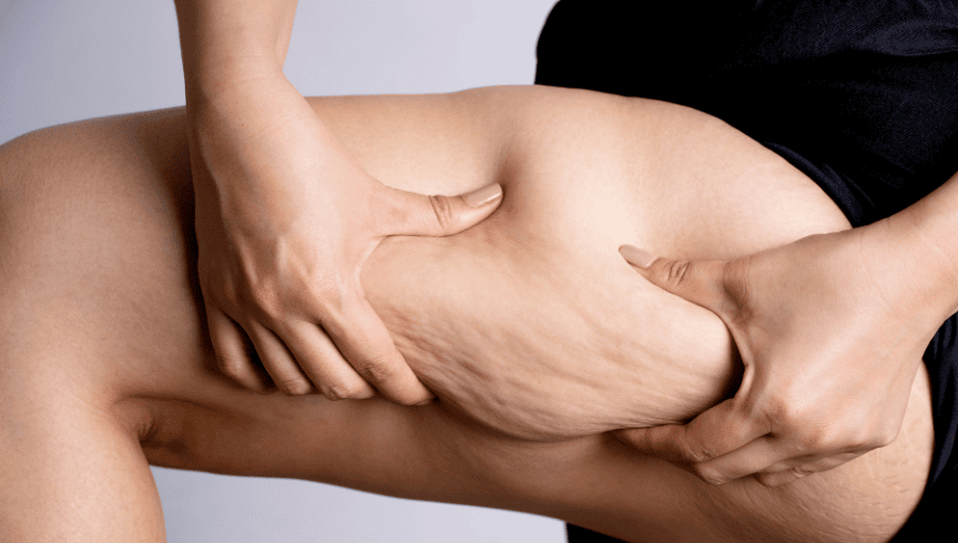 Liposucción de piernas: cómo funciona y qué resultados ofrece 11_ Liposucción piernas (2)
