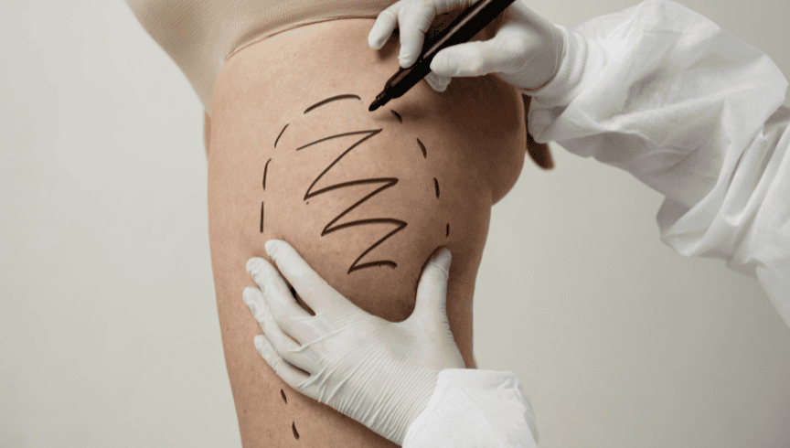 11_ Liposucción piernas (3)